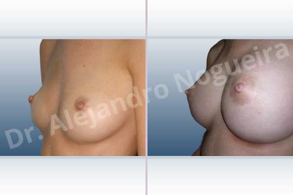 Asymmetric breasts,Cross eyed breasts,Lateral breasts,Skinny breasts,Too far apart wide cleavage breasts,Anatomical shape,Extra large size,Lower hemi periareolar incision,Subfascial pocket plane - photo 3