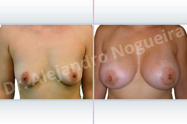 Asymmetric breasts,Empty breasts,Mildly saggy droopy breasts,Moderately saggy droopy breasts,Small breasts,Anatomical shape,Extra large size,Lower hemi periareolar incision,Subfascial pocket plane - photo 1