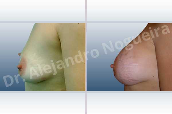 Asymmetric breasts,Empty breasts,Mildly saggy droopy breasts,Moderately saggy droopy breasts,Small breasts,Anatomical shape,Extra large size,Lower hemi periareolar incision,Subfascial pocket plane - photo 2