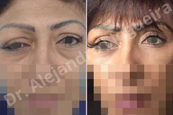 Baggy lower eyelids,Baggy upper eyelids,Saggy upper eyelids,Upper eyelids ptosis,Lower eyelid fat bags resection,Transconjunctival approach incision,Upper eyelid fat bags resection,Upper eyelid skin and muscle resection - photo 2