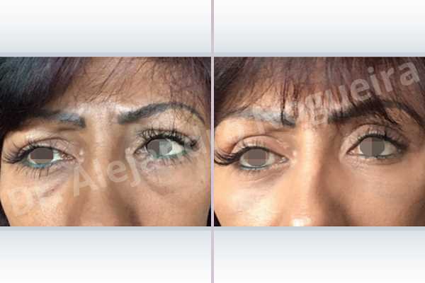 Baggy lower eyelids,Baggy upper eyelids,Saggy upper eyelids,Upper eyelids ptosis,Lower eyelid fat bags resection,Transconjunctival approach incision,Upper eyelid fat bags resection,Upper eyelid skin and muscle resection - photo 4
