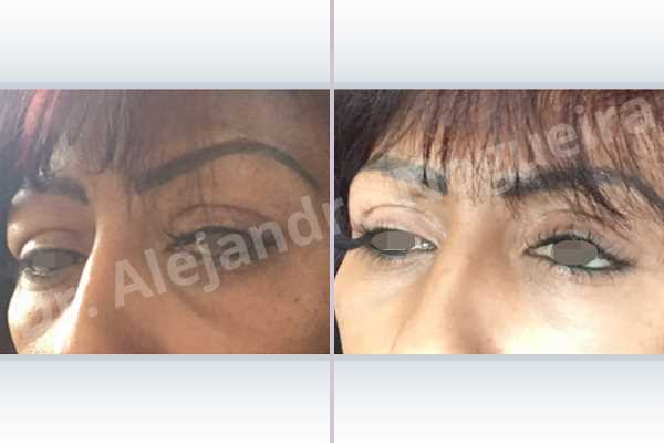 Baggy lower eyelids,Baggy upper eyelids,Saggy upper eyelids,Upper eyelids ptosis,Lower eyelid fat bags resection,Transconjunctival approach incision,Upper eyelid fat bags resection,Upper eyelid skin and muscle resection - photo 6