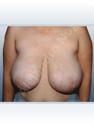 Asymmetric breasts,Breast tissue bottoming out,Cross eyed breasts,Extremely large breasts,Extremely saggy droopy breasts,Pendulous breasts,Severely large breasts,Severely saggy droopy breasts,Tuberous breasts,Anchor incision,Double vertical pedicle