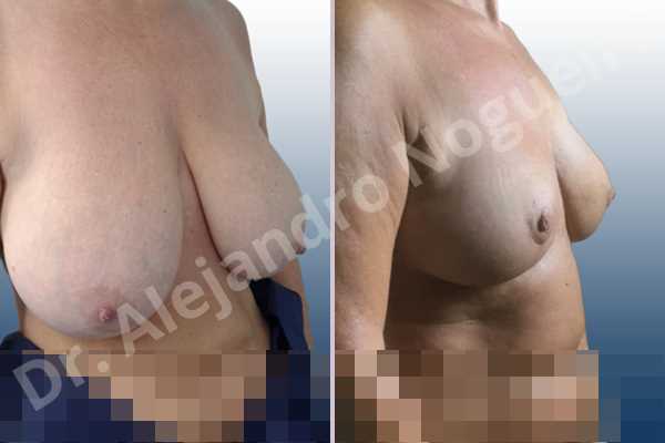 Asymmetric breasts,Breast tissue bottoming out,Cross eyed breasts,Extremely saggy droopy breasts,Mildly large breasts,Pendulous breasts,Severely large breasts,Tuberous breasts,Anchor incision,Double vertical pedicle - photo 5