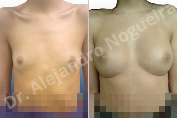Asymmetric breasts,Lateral breasts,Narrow breasts,Skinny breasts,Small breasts,Too far apart wide cleavage breast implants,Anatomical shape,Inframammary incision,Subfascial pocket plane - photo 1