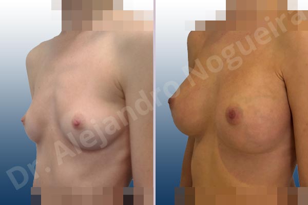 Asymmetric breasts,Empty breasts,Lateral breasts,Narrow breasts,Skinny breasts,Small breasts,Sunken chest,Too far apart wide cleavage breasts,Anatomical shape,Extra large size,Inframammary incision,Subfascial pocket plane - photo 3