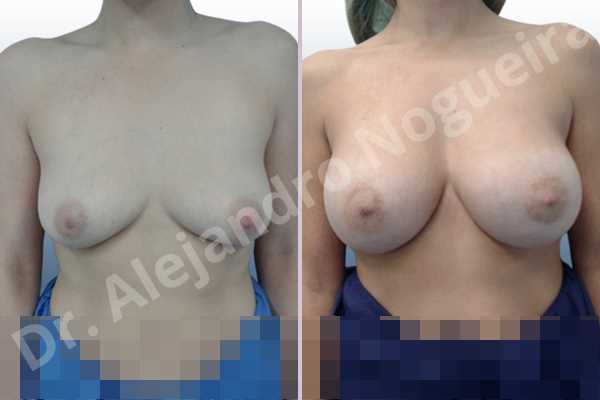 Empty breasts,Moderately saggy droopy breasts,Slightly large breasts,Wide breasts,Anatomical shape,Extra large size,Lower hemi periareolar incision,Subfascial pocket plane - photo 1
