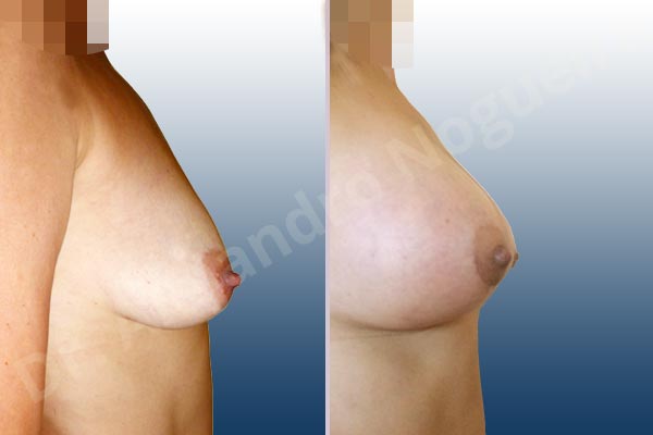 Empty breasts,Lateral breasts,Moderately saggy droopy breasts,Pigeon chest,Small breasts,Too far apart wide cleavage breasts,Tuberous breasts,Wide breasts,Anatomical shape,Extra large size,Lower hemi periareolar incision,Subfascial pocket plane,Tuberous mammoplasty - photo 4