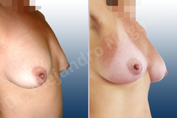 Empty breasts,Lateral breasts,Moderately saggy droopy breasts,Pigeon chest,Small breasts,Too far apart wide cleavage breasts,Tuberous breasts,Wide breasts,Anatomical shape,Extra large size,Lower hemi periareolar incision,Subfascial pocket plane,Tuberous mammoplasty - photo 5