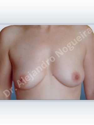 Asymmetric breasts,Empty breasts,Mildly saggy droopy breasts,Small breasts,Anatomical shape,Lower hemi periareolar incision,Subfascial pocket plane,Extra large size