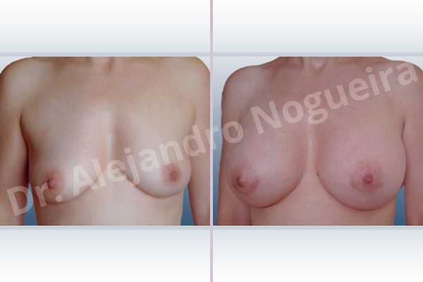 Asymmetric breasts,Empty breasts,Mildly saggy droopy breasts,Small breasts,Anatomical shape,Lower hemi periareolar incision,Subfascial pocket plane,Extra large size - photo 1