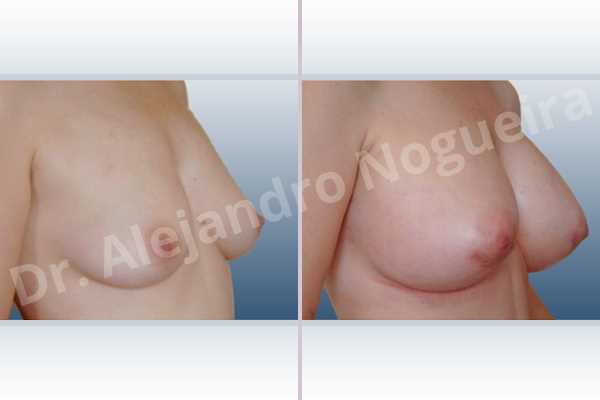 Asymmetric breasts,Empty breasts,Mildly saggy droopy breasts,Small breasts,Anatomical shape,Lower hemi periareolar incision,Subfascial pocket plane,Extra large size - photo 5