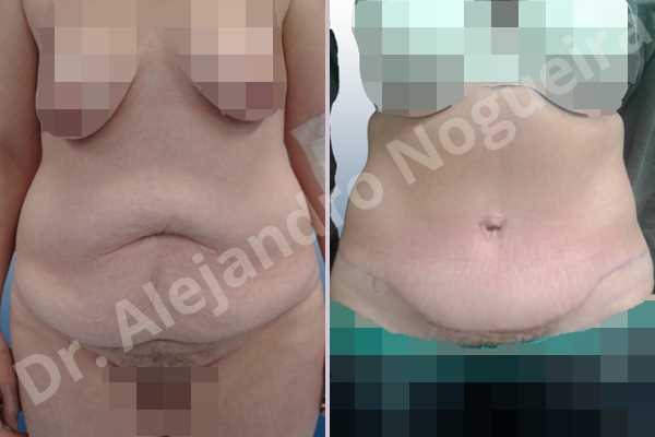 Saggy abdomen,Weak abdomen muscles,Standard abdominoplasty - photo 1