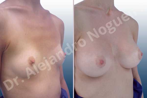 Empty breasts,Narrow breasts,Skinny breasts,Small breasts,Sunken chest,Too far apart wide cleavage breasts,Anatomical shape,Lower hemi periareolar incision,Subfascial pocket plane - photo 5