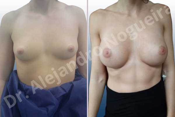 Empty breasts,Lateral breasts,Skinny breasts,Small breasts,Too far apart wide cleavage breasts,Wide breasts,Anatomical shape,Extra large size,Inframammary incision,Subfascial pocket plane - photo 1