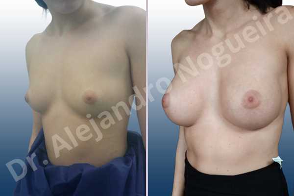 Empty breasts,Lateral breasts,Skinny breasts,Small breasts,Too far apart wide cleavage breasts,Wide breasts,Anatomical shape,Extra large size,Inframammary incision,Subfascial pocket plane - photo 3