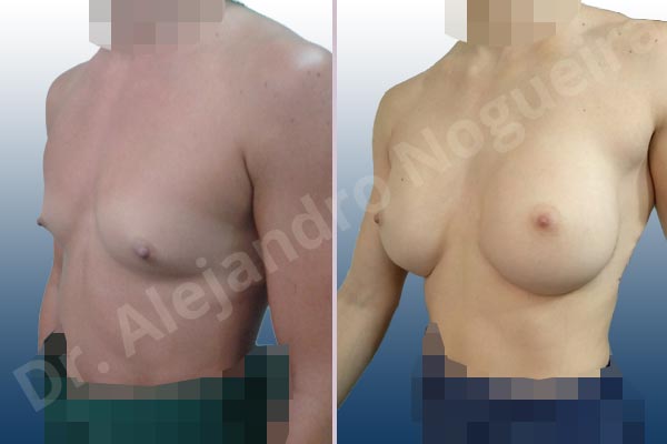 Asymmetric breasts,Empty breasts,Lateral breasts,Narrow breasts,Pigeon chest,Skinny breasts,Small breasts,Sunken chest,Too far apart wide cleavage breasts,Anatomical shape,Inframammary incision,Subfascial pocket plane - photo 3