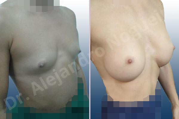 Asymmetric breasts,Empty breasts,Lateral breasts,Narrow breasts,Pigeon chest,Skinny breasts,Small breasts,Sunken chest,Too far apart wide cleavage breasts,Anatomical shape,Inframammary incision,Subfascial pocket plane - photo 5