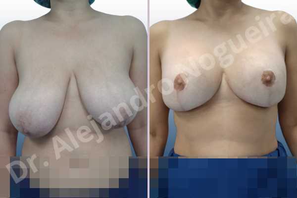 Asymmetric breasts,Empty breasts,Extremely saggy droopy breasts,Large areolas,Lateral breasts,Pendulous breasts,Severely large breasts,Too far apart wide cleavage breasts,Tuberous breasts,Anatomical shape,Anchor incision,Areola reduction,Double vertical pedicle,Extra large size,Subfascial pocket plane - photo 1