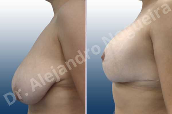 Asymmetric breasts,Empty breasts,Extremely saggy droopy breasts,Large areolas,Lateral breasts,Pendulous breasts,Severely large breasts,Too far apart wide cleavage breasts,Tuberous breasts,Anatomical shape,Anchor incision,Areola reduction,Double vertical pedicle,Extra large size,Subfascial pocket plane - photo 3