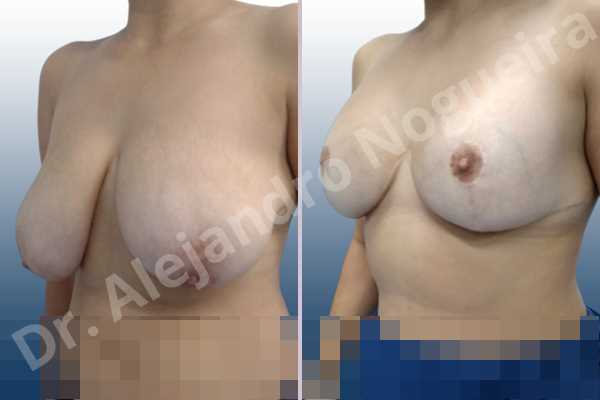 Asymmetric breasts,Empty breasts,Extremely saggy droopy breasts,Large areolas,Lateral breasts,Pendulous breasts,Severely large breasts,Too far apart wide cleavage breasts,Tuberous breasts,Anatomical shape,Anchor incision,Areola reduction,Double vertical pedicle,Extra large size,Subfascial pocket plane - photo 4