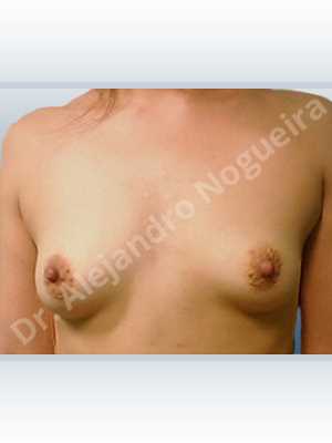 Asymmetric breasts,Lateral breasts,Small breasts,Too far apart wide cleavage breasts,Tuberous breasts,Anatomical shape,Areola reduction,Circumareolar incision,Subfascial pocket plane,Tuberous mammoplasty,Extra large size