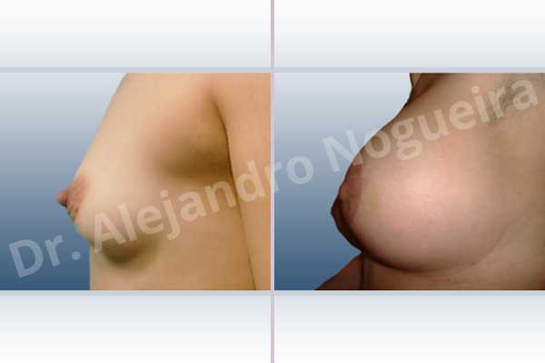 Asymmetric breasts,Lateral breasts,Small breasts,Too far apart wide cleavage breasts,Tuberous breasts,Anatomical shape,Areola reduction,Circumareolar incision,Subfascial pocket plane,Tuberous mammoplasty,Extra large size - photo 2