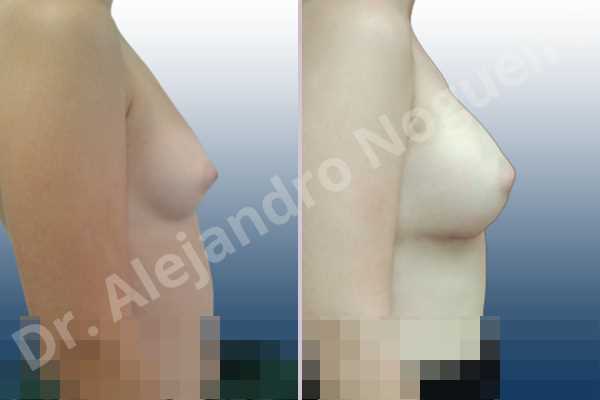 Asymmetric breasts,Empty breasts,Lateral breasts,Narrow breasts,Small breasts,Too far apart wide cleavage breasts,Anatomical shape,Inframammary incision,Subfascial pocket plane - photo 4