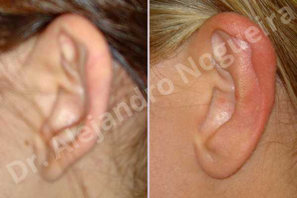 Prominent ears,Mustardé antihelical suturing - photo 2