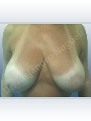 Extremely saggy droopy breasts,Large areolas,Lateral breasts,Pendulous breasts,Tuberous breasts,Anchor incision,Areola reduction,Double vertical pedicle
