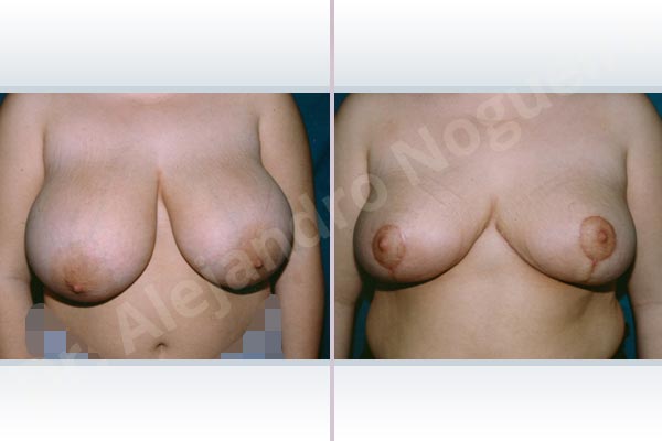 Asymmetric breasts,Breast tissues symmastia uniboob,Extremely saggy droopy breasts,Large areolas,Lateral breasts,Pendulous breasts,Severely large breasts,Tuberous breasts,Anchor incision,Areola reduction,Double vertical pedicle - photo 1
