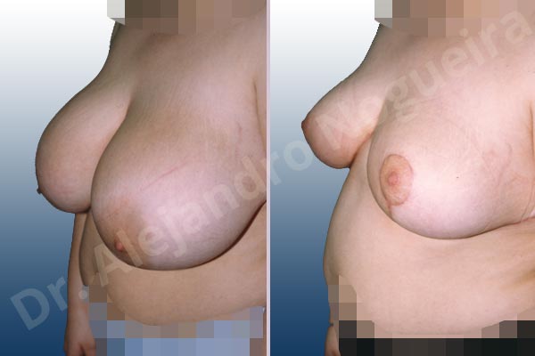 Asymmetric breasts,Breast tissues symmastia uniboob,Extremely saggy droopy breasts,Large areolas,Lateral breasts,Pendulous breasts,Severely large breasts,Tuberous breasts,Anchor incision,Areola reduction,Double vertical pedicle - photo 2