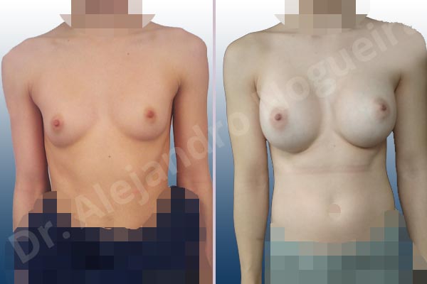 Asymmetric breasts,Empty breasts,Narrow breasts,Skinny breasts,Small breasts,Too far apart wide cleavage breasts,Anatomical shape,Inframammary incision,Subfascial pocket plane - photo 1