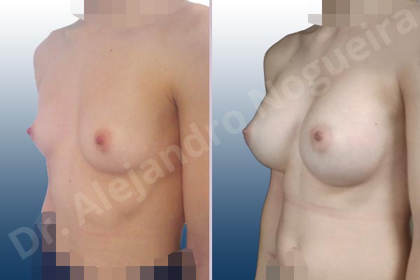 Asymmetric breasts,Empty breasts,Narrow breasts,Skinny breasts,Small breasts,Too far apart wide cleavage breasts,Anatomical shape,Inframammary incision,Subfascial pocket plane - photo 3