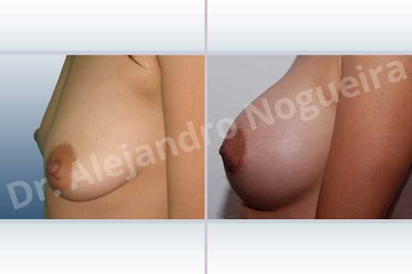 Asymmetric breasts,Empty breasts,Lateral breasts,Mildly saggy droopy breasts,Slightly saggy droopy breasts,Small breasts,Too far apart wide cleavage breasts,Anatomical shape,Lower hemi periareolar incision,Subfascial pocket plane - photo 2