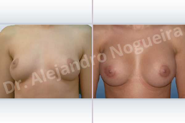 Asymmetric breasts,Cross eyed breasts,Lateral breasts,Small breasts,Too far apart wide cleavage breasts,Round shape,Lower hemi periareolar incision,Subfascial pocket plane - photo 1