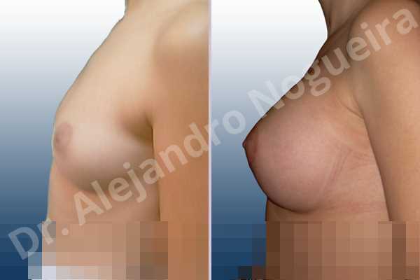 Asymmetric breasts,Cross eyed breasts,Lateral breasts,Small breasts,Too far apart wide cleavage breasts,Round shape,Lower hemi periareolar incision,Subfascial pocket plane - photo 2