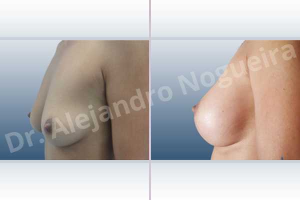Cross eyed breasts,Empty breasts,Moderately saggy droopy breasts,Small breasts,Anatomical shape,Lower hemi periareolar incision,Subfascial pocket plane - photo 2