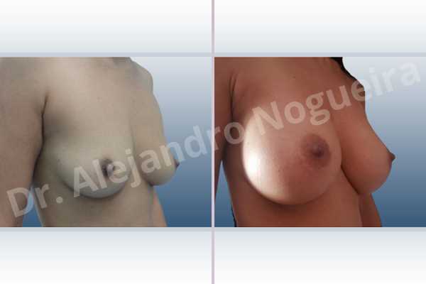 Cross eyed breasts,Empty breasts,Moderately saggy droopy breasts,Small breasts,Anatomical shape,Lower hemi periareolar incision,Subfascial pocket plane - photo 5