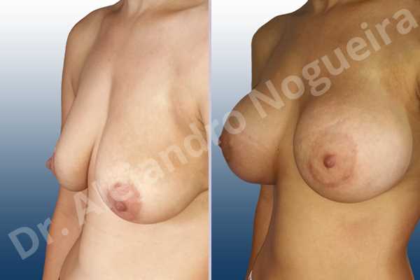 Empty breasts,Lateral breasts,Pendulous breasts,Severely saggy droopy breasts,Skinny breasts,Slightly large breasts,Too far apart wide cleavage breasts,Lower hemi periareolar incision,Round shape,Subfascial pocket plane - photo 3