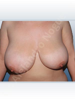 Asymmetric breasts,Breast tissues symmastia uniboob,Extremely large breasts,Extremely saggy droopy breasts,Severely large breasts,Severely saggy droopy breasts,Tuberous breasts,Anchor incision,Double vertical pedicle