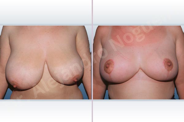 Asymmetric breasts,Breast tissues symmastia uniboob,Extremely large breasts,Extremely saggy droopy breasts,Severely large breasts,Severely saggy droopy breasts,Tuberous breasts,Anchor incision,Double vertical pedicle - photo 1