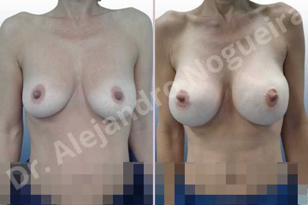 Asymmetric breasts,Empty breasts,Mildly saggy droopy breasts,Pendulous breasts,Skinny breasts,Small breasts,Sunken chest,Anatomical shape,Lower hemi periareolar incision,Subfascial pocket plane - photo 1