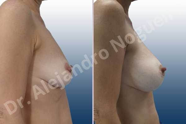Asymmetric breasts,Empty breasts,Mildly saggy droopy breasts,Pendulous breasts,Skinny breasts,Small breasts,Sunken chest,Anatomical shape,Lower hemi periareolar incision,Subfascial pocket plane - photo 4