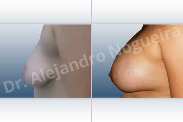 Asymmetric breasts,Empty breasts,Moderately saggy droopy breasts,Narrow breasts,Pendulous breasts,Severely saggy droopy breasts,Small breasts,Sunken chest,Too far apart wide cleavage breasts,Tuberous breasts,Anatomical shape,Lower hemi periareolar incision,Subfascial pocket plane,Tuberous mammoplasty - photo 2
