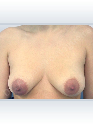 Asymmetric breasts,Cross eyed breasts,Empty breasts,Large areolas,Lateral breasts,Mildly saggy droopy breasts,Moderately saggy droopy breasts,Small breasts,Too far apart wide cleavage breasts,Tuberous breasts,Wide breasts,Anatomical shape,Areola reduction,Circumareolar incision,Subfascial pocket plane,Tuberous mammoplasty