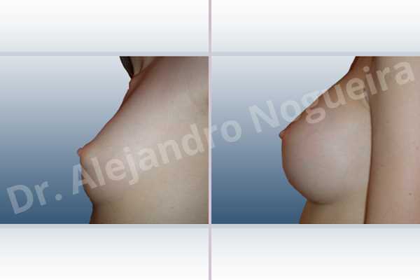 Asymmetric breasts,Cross eyed breasts,Small breasts,Anatomical shape,Inframammary incision,Subfascial pocket plane - photo 2