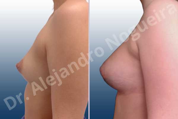 Asymmetric breasts,Cross eyed breasts,Empty breasts,Small breasts,Anatomical shape,Lower hemi periareolar incision,Subfascial pocket plane - photo 2