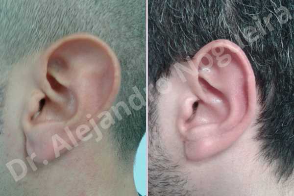 Large earlobes,Large ears,Prominent earlobes,Prominent ears,Fleur de lis cephalic ear resection,L shape earlobe resection - photo 2