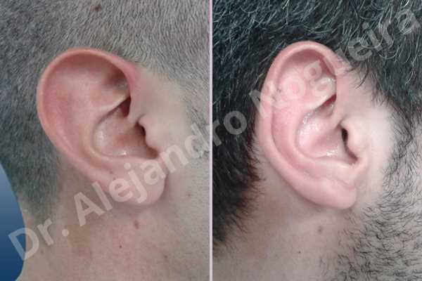 Large earlobes,Large ears,Prominent earlobes,Prominent ears,Fleur de lis cephalic ear resection,L shape earlobe resection - photo 4